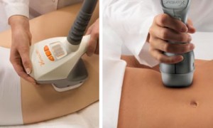 velashape-treatment3